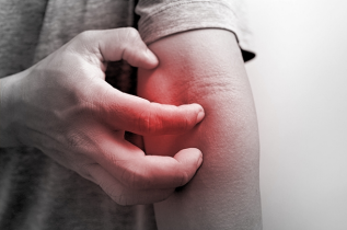 Atopic Dermatitis (AD)